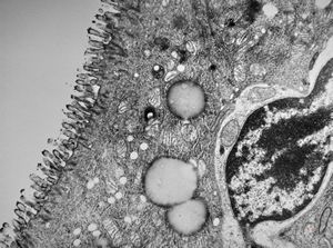 celiakia- lymphocytic invasion celiakia- lymphocytic invasion